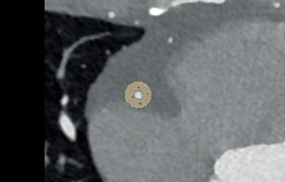 Pericoronary radiomics texture features associated with hypercholesterolemia on a photon-counting-CT